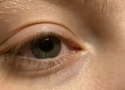 Under-Eye Hollows and Tear Troughs: What They Are and What You Can Do