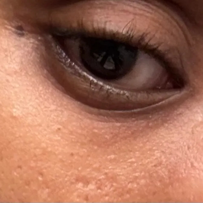 dark circles 