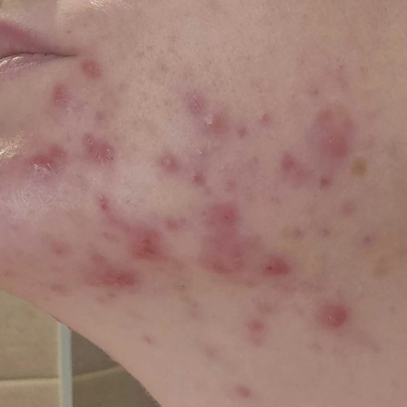 adult with acne on their face