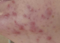 Adult Acne: Why It Happens After 25 and What to Do About It