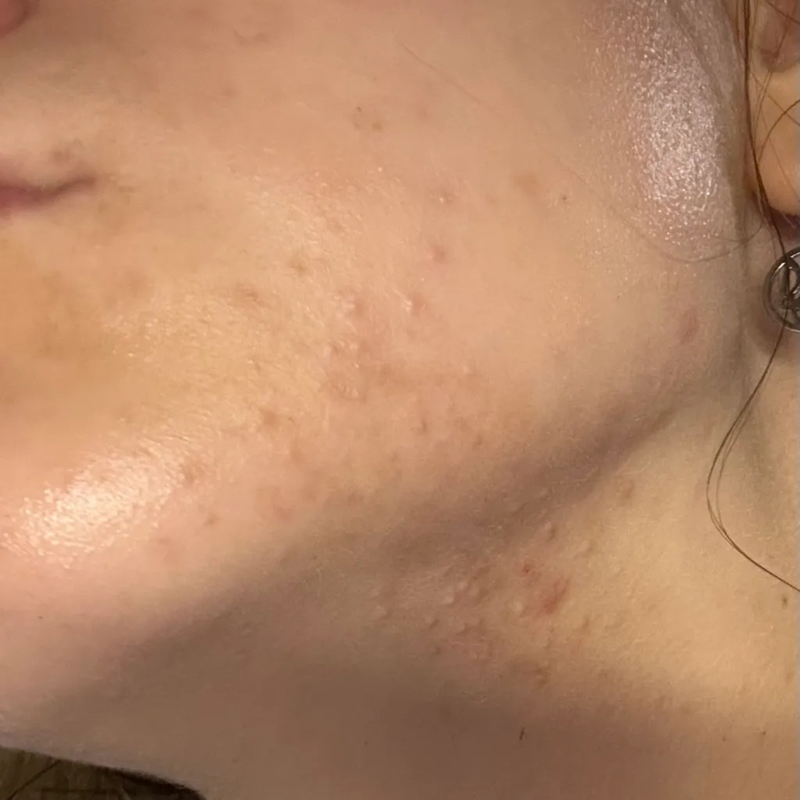 stress related acne