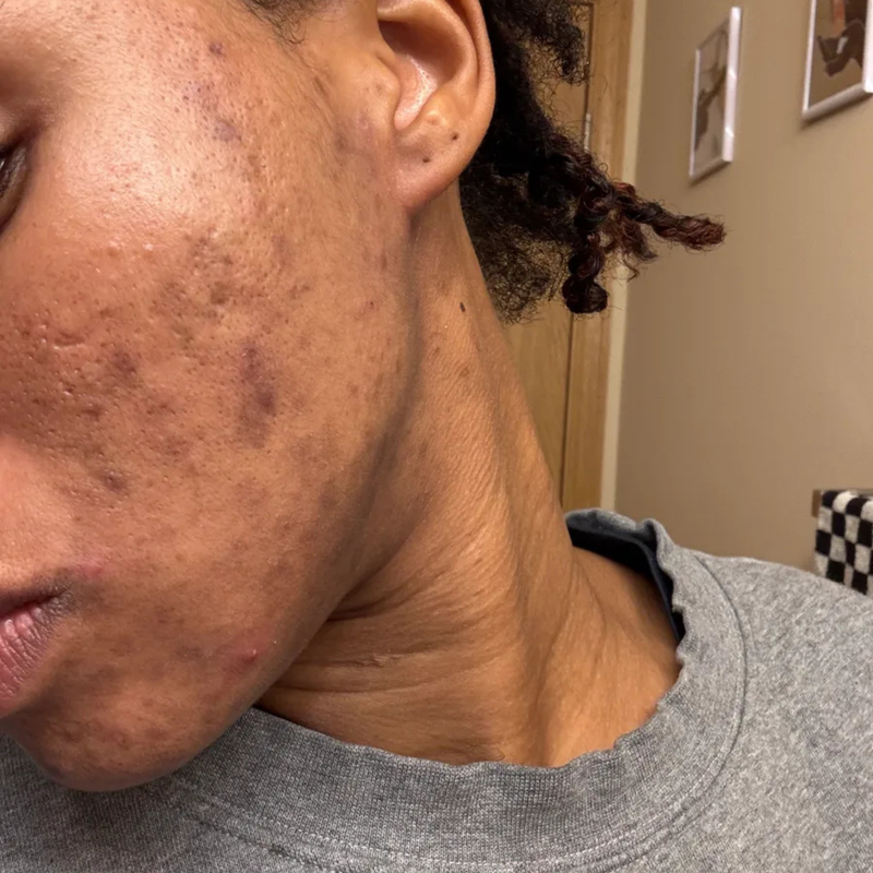 woman with acne on her face
