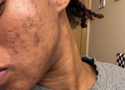 Does Diet Cause Acne? What the Science Actually Says