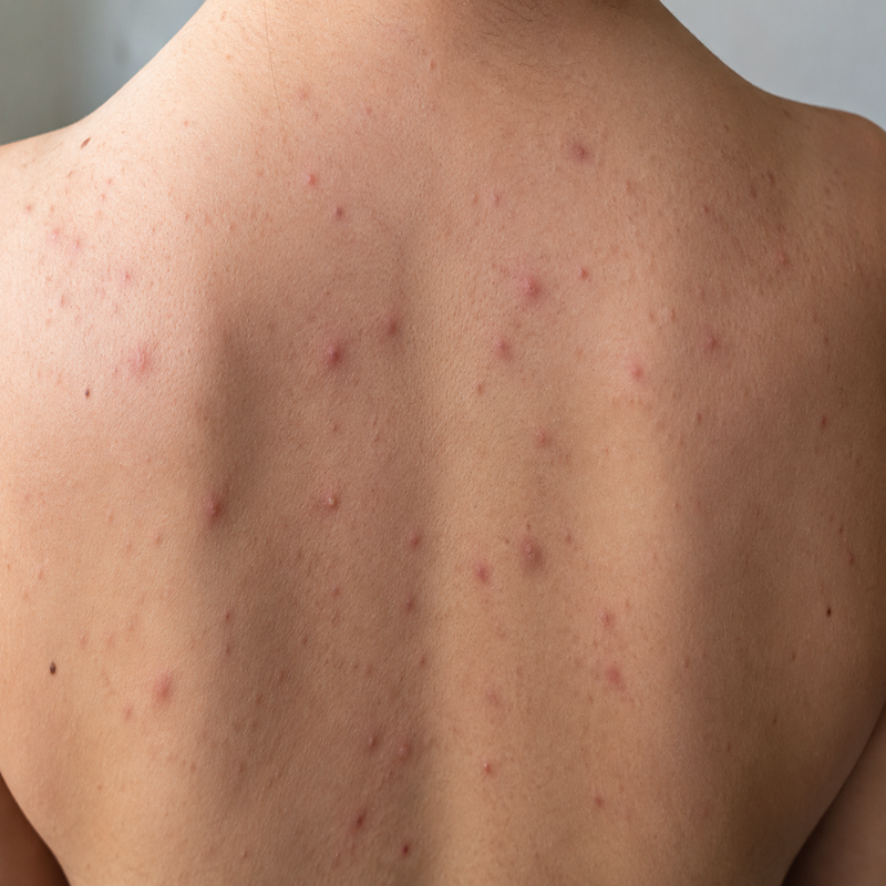 back acne