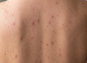 What Causes Back Acne in Females? Hormones, Periods & How to Treat It