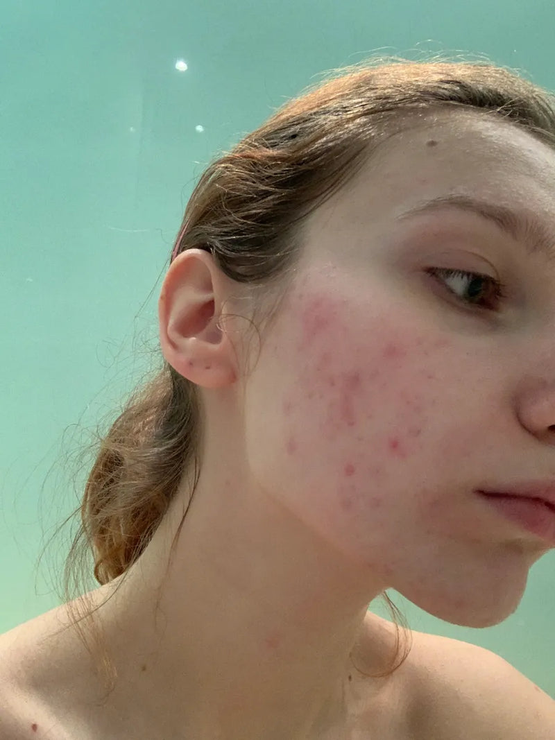 woman with breakouts on her face