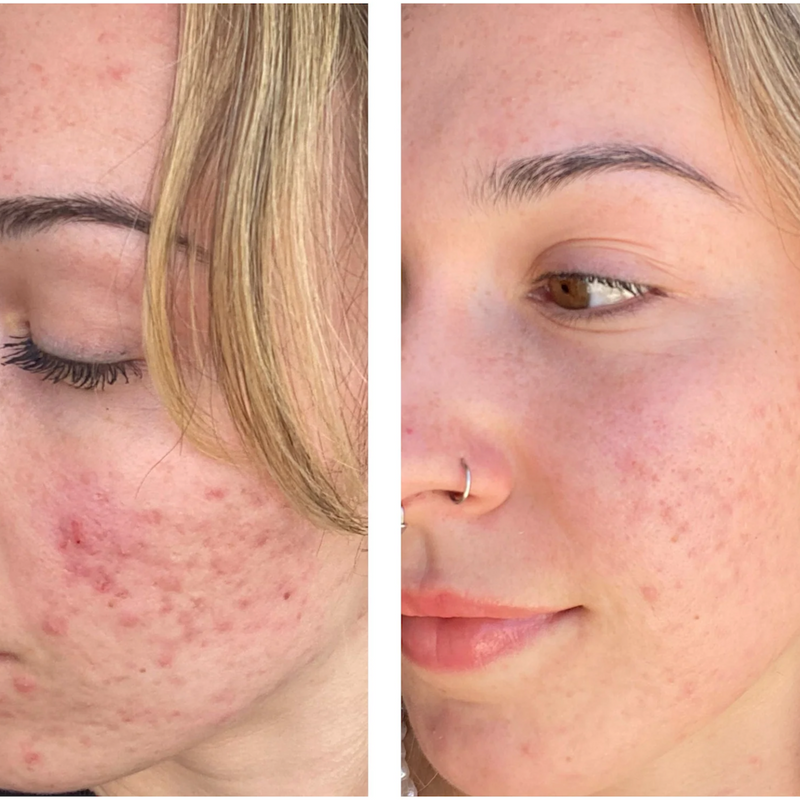 Before after using Azealic acid for scars
