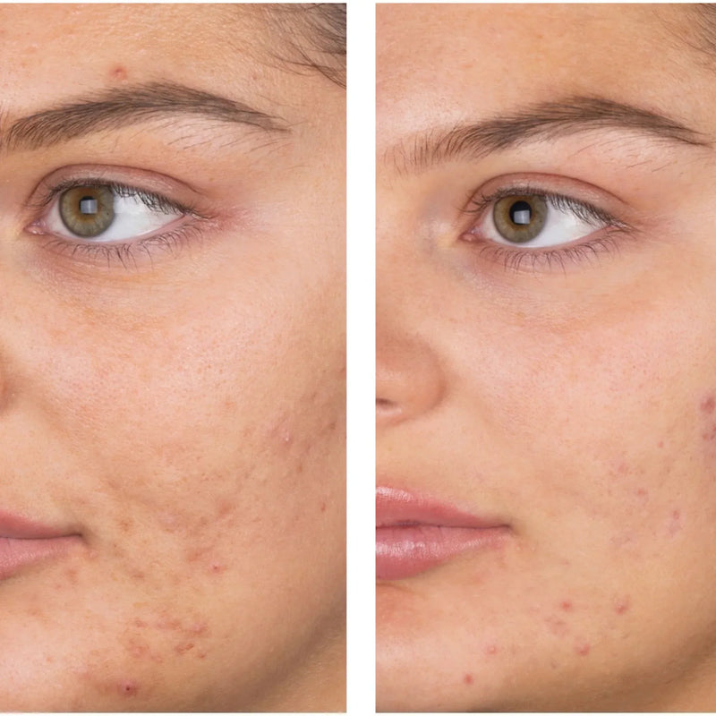 woman with acne scars