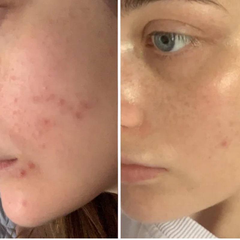 Before and after of scarring
