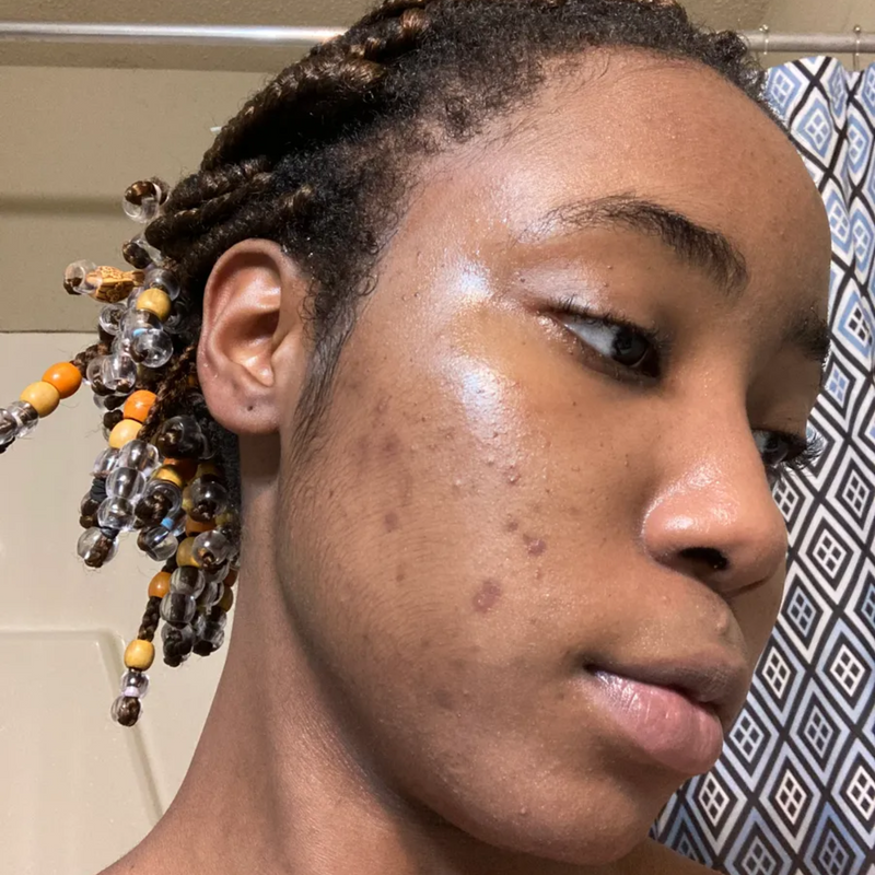 person with acne scars