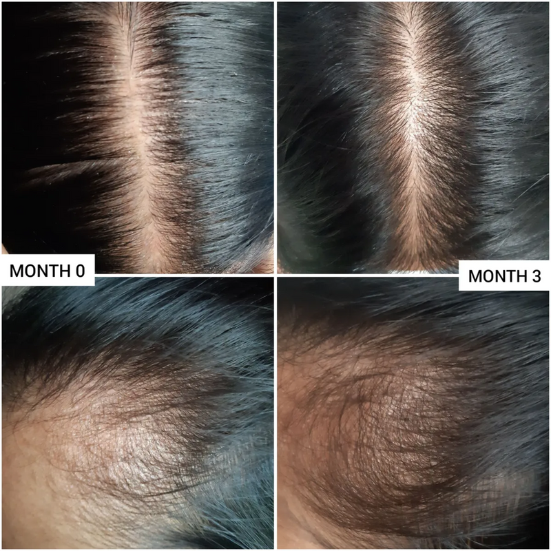 before and after using caffeine scalp treatment