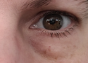How to Get Rid of Bags Under the Eyes: Causes, Treatments and What Actually Works
