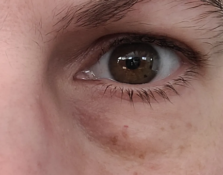 Close up of under eye bags