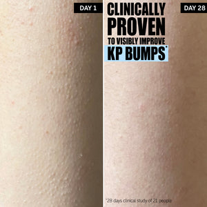 Clinically proven to visibly improve KP bumps*. The difference after 28 days use.