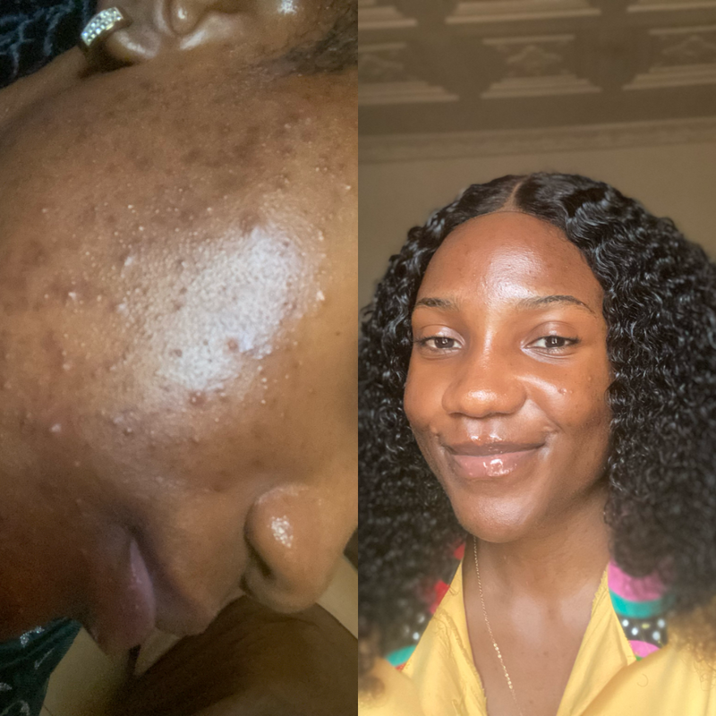 A before and after image, the before shows textured acne prone skin.