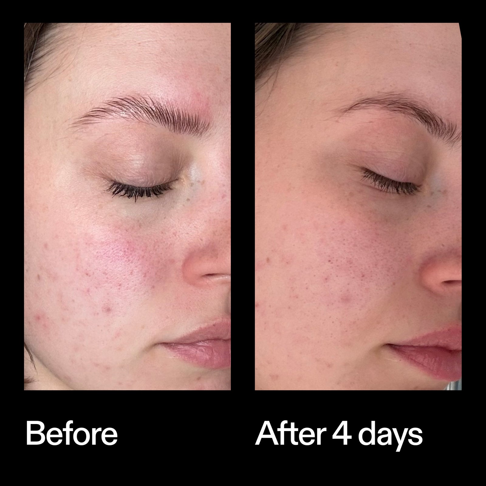 Before and after results using The INKEY List Azelaic Acid Redness Relief Solution after 4 days