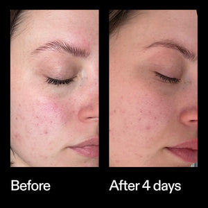 Before and after results using The INKEY List Azelaic Acid Redness Relief Solution after 4 days