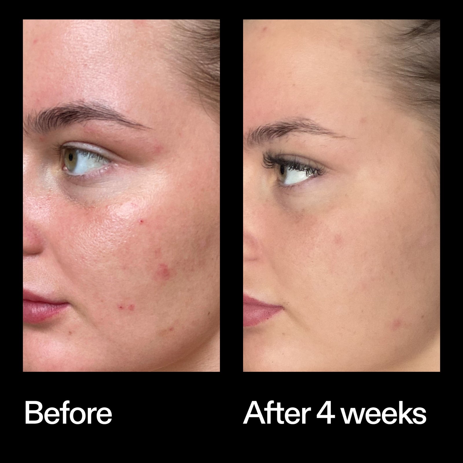 Before and after results using The INKEY List Azelaic Acid Redness Relief Solution after 4 weeks