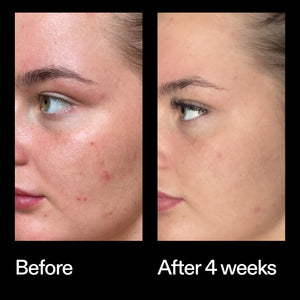 Before and after results using The INKEY List Azelaic Acid Redness Relief Solution after 4 weeks
