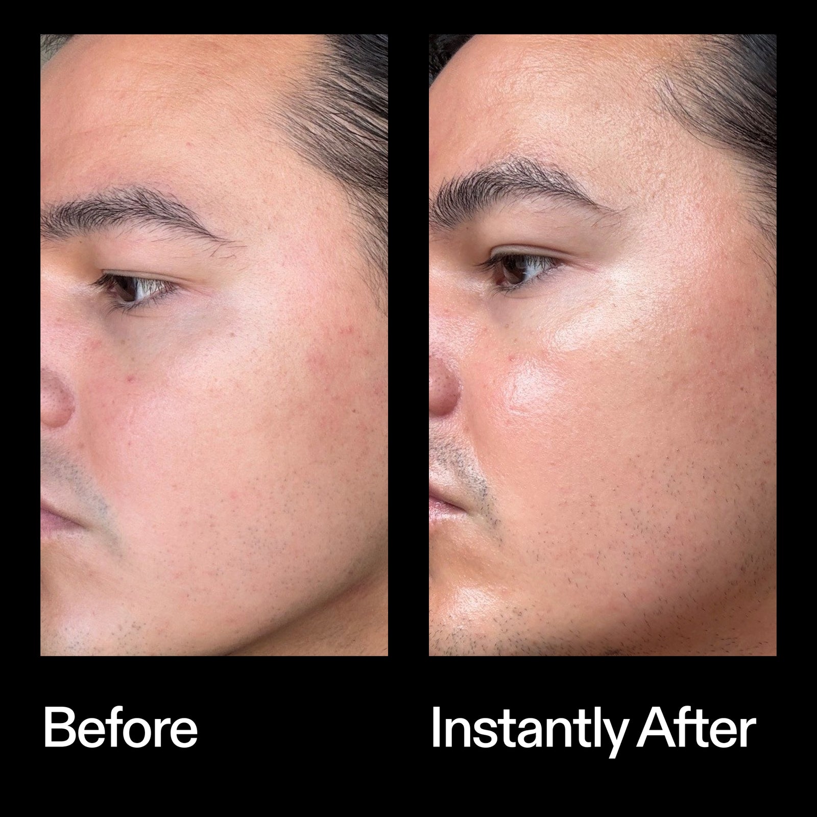 Before and instant after results using The INKEY List Azelaic Acid Redness Relief Solution