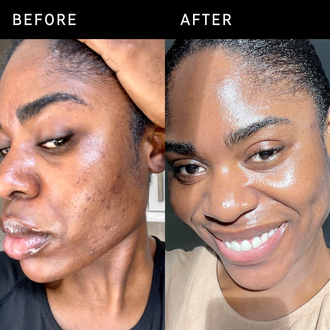 Before and after of an INKEY customer using Omega Water Cream. 