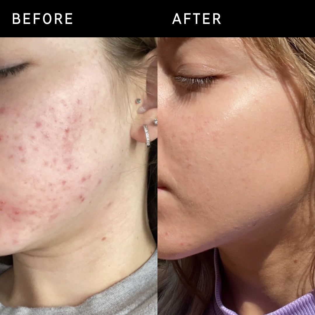 Before & After of customer using Niacinamide Serum