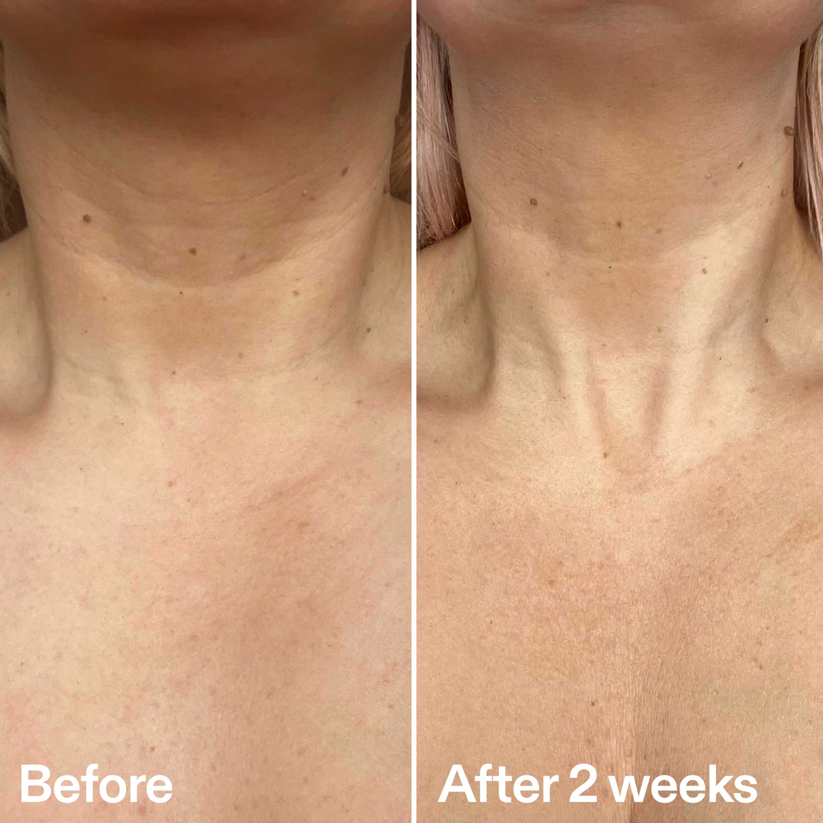 Before and after comparison of neck skin texture with 'Before' on the left and 'After 2 weeks' on the right.