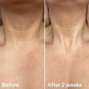 Before and after comparison of neck skin texture with 'Before' on the left and 'After 2 weeks' on the right.