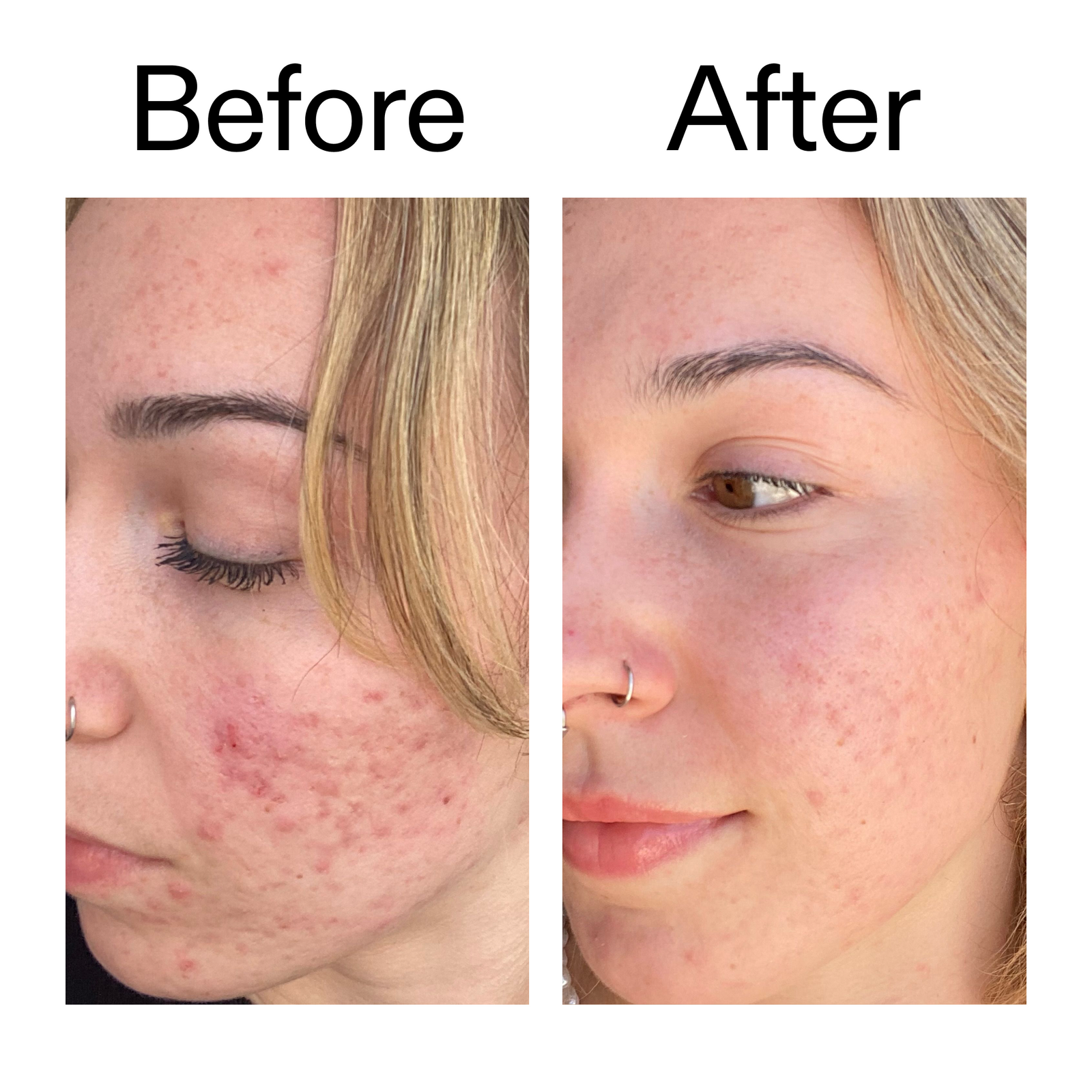 Before and after comparison of a person's face with acne on a white background