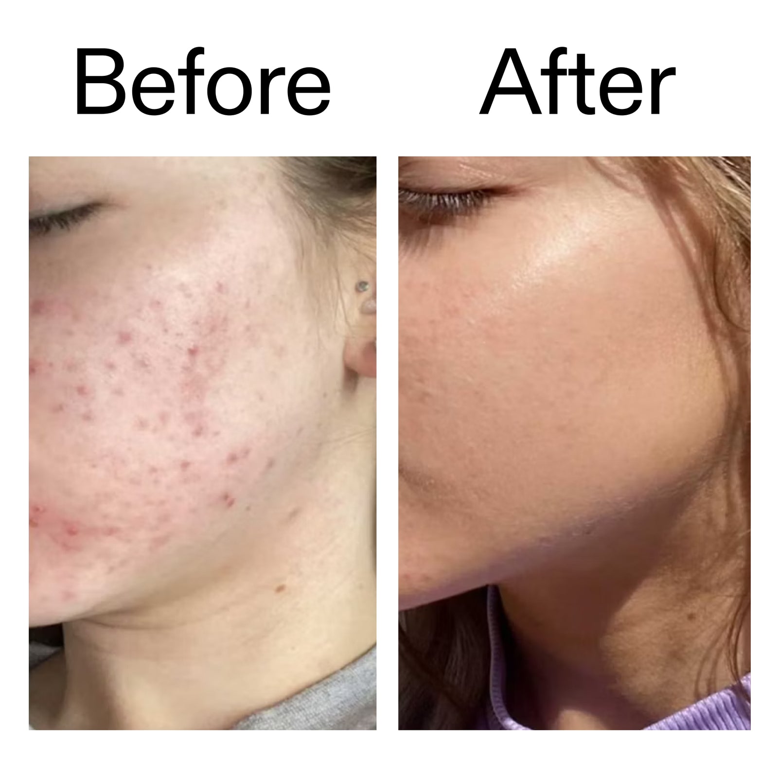 Before and After of customer using Beta Hydroxy Acid displaying positive results from continued use 
