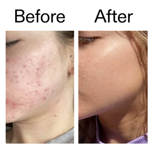 Before and After of customer using Beta Hydroxy Acid displaying positive results from continued use 