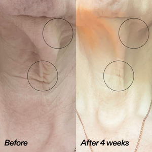 Before-and-after comparison of skin texture on the neck, showing wrinkles circled in black on the left and smoother skin after 4 weeks on the right.