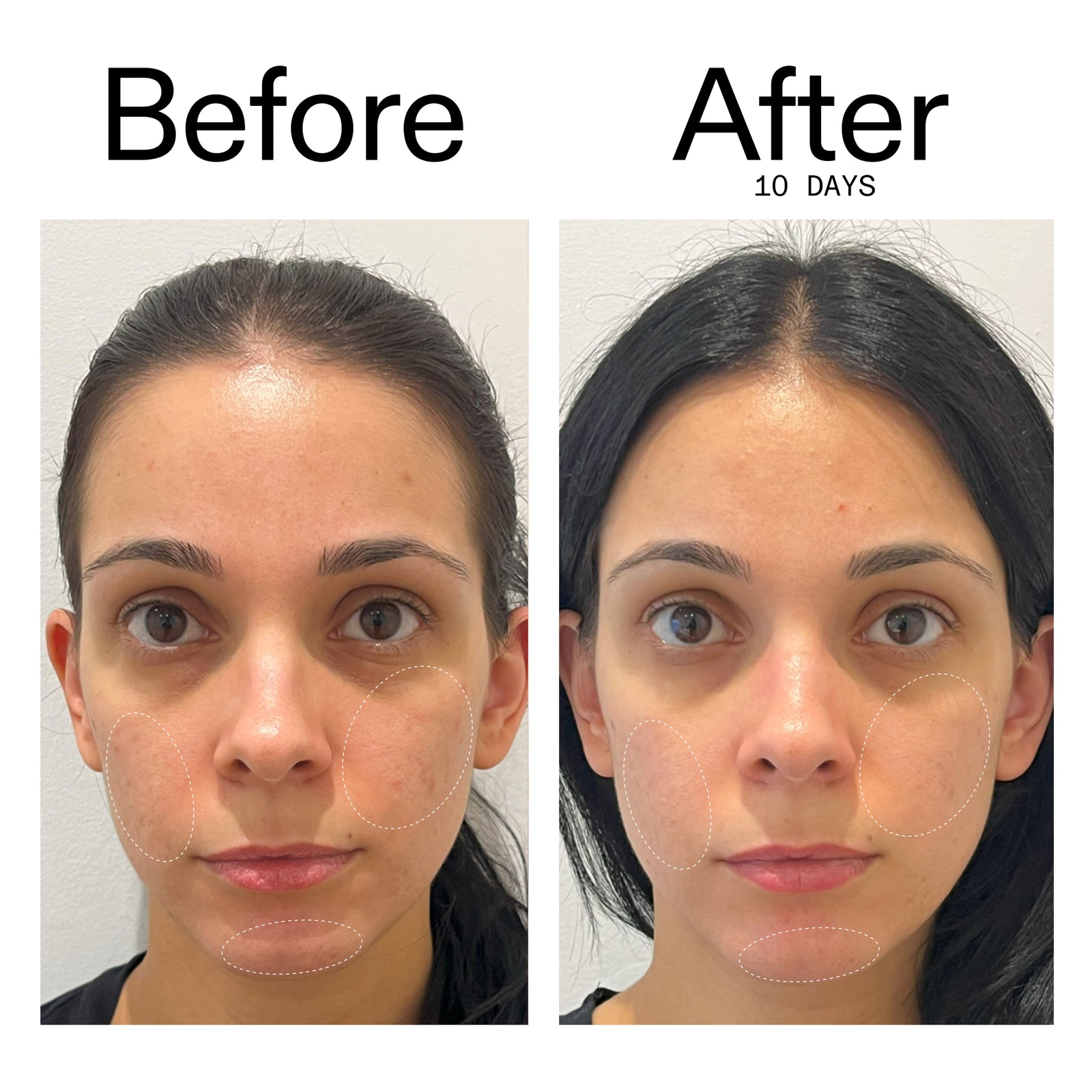 Before and after 10 days showing reduced blemish marks