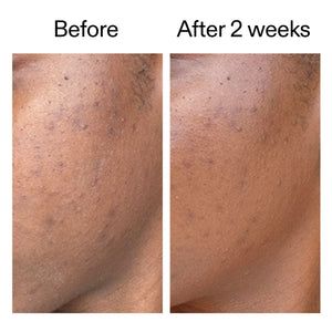 Before and after 2 weeks showing faded blemish marks