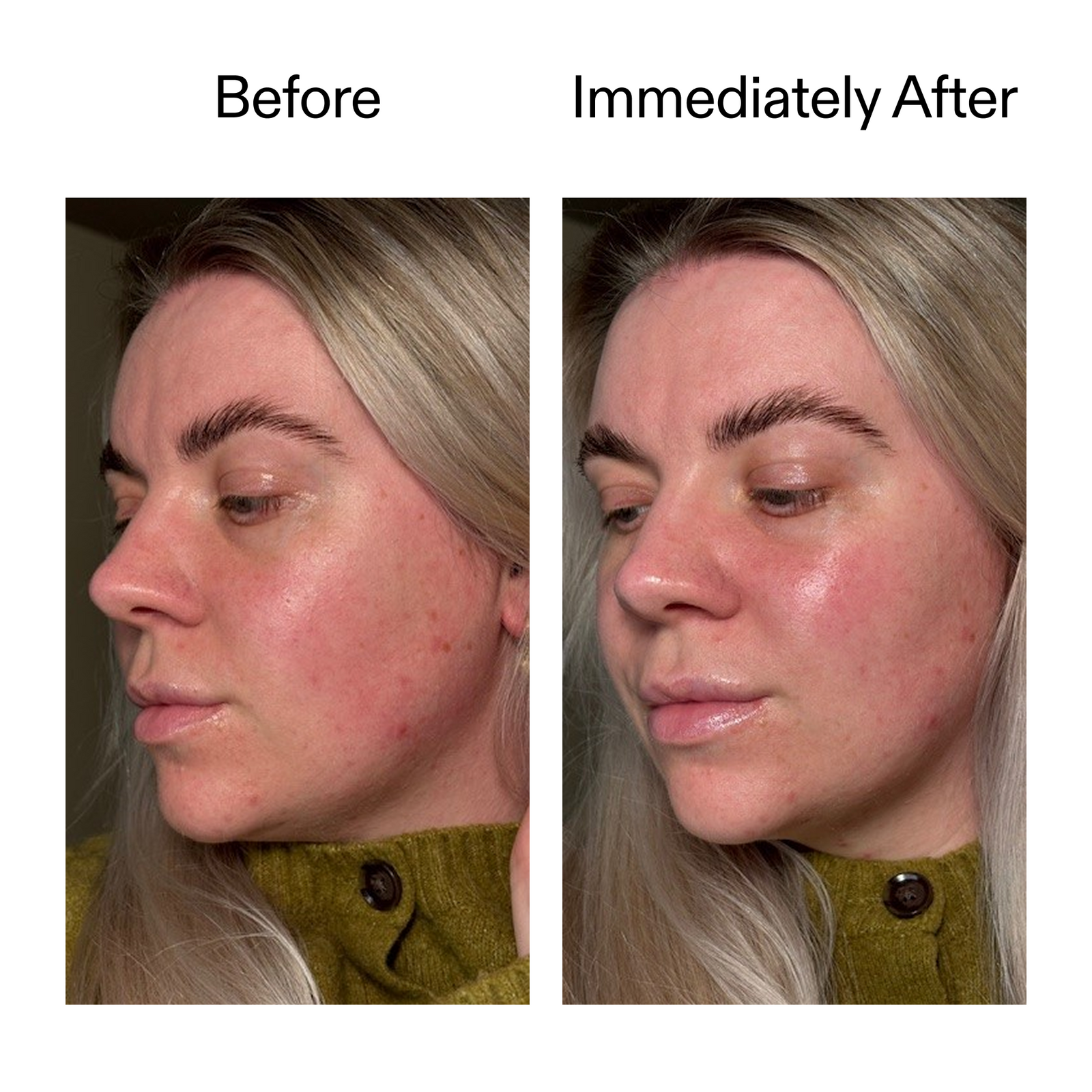 Before and after comparison of a person's face with visible acne treatment.