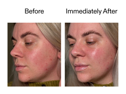 Before and after comparison of a woman's face with acne on a plain background