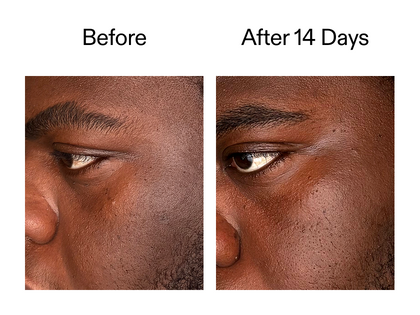 Before and after comparison of a person's eye area with text indicating time elapsed.