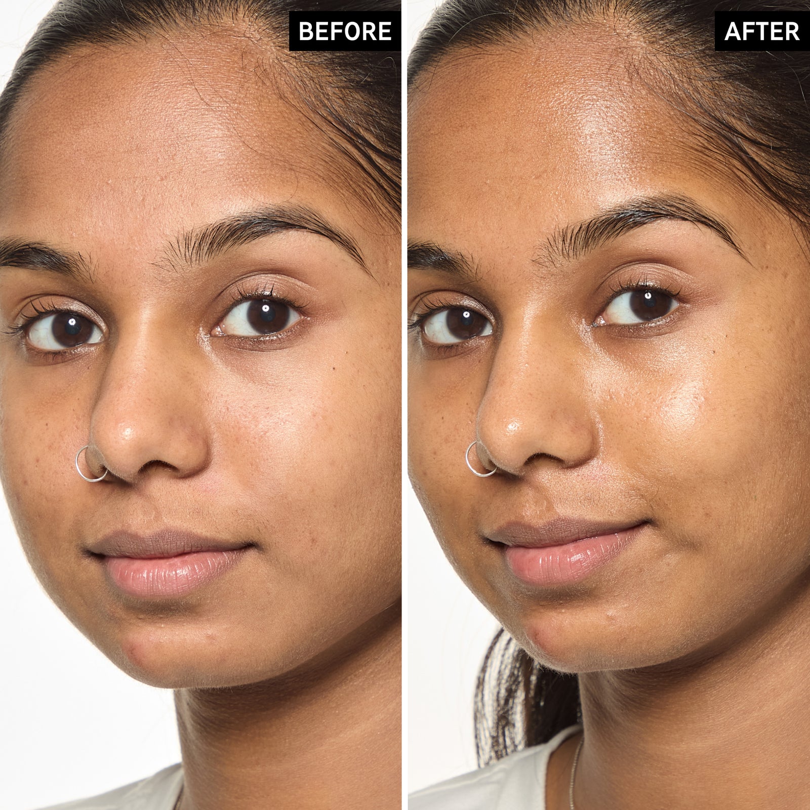 Before and after comparison of a woman's face with a visible improvement after using Exosome