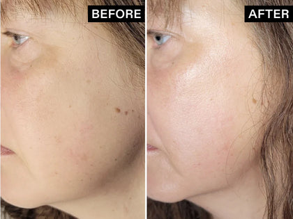 Before and after comparison of a person's face with visible skin texture and blemishes.