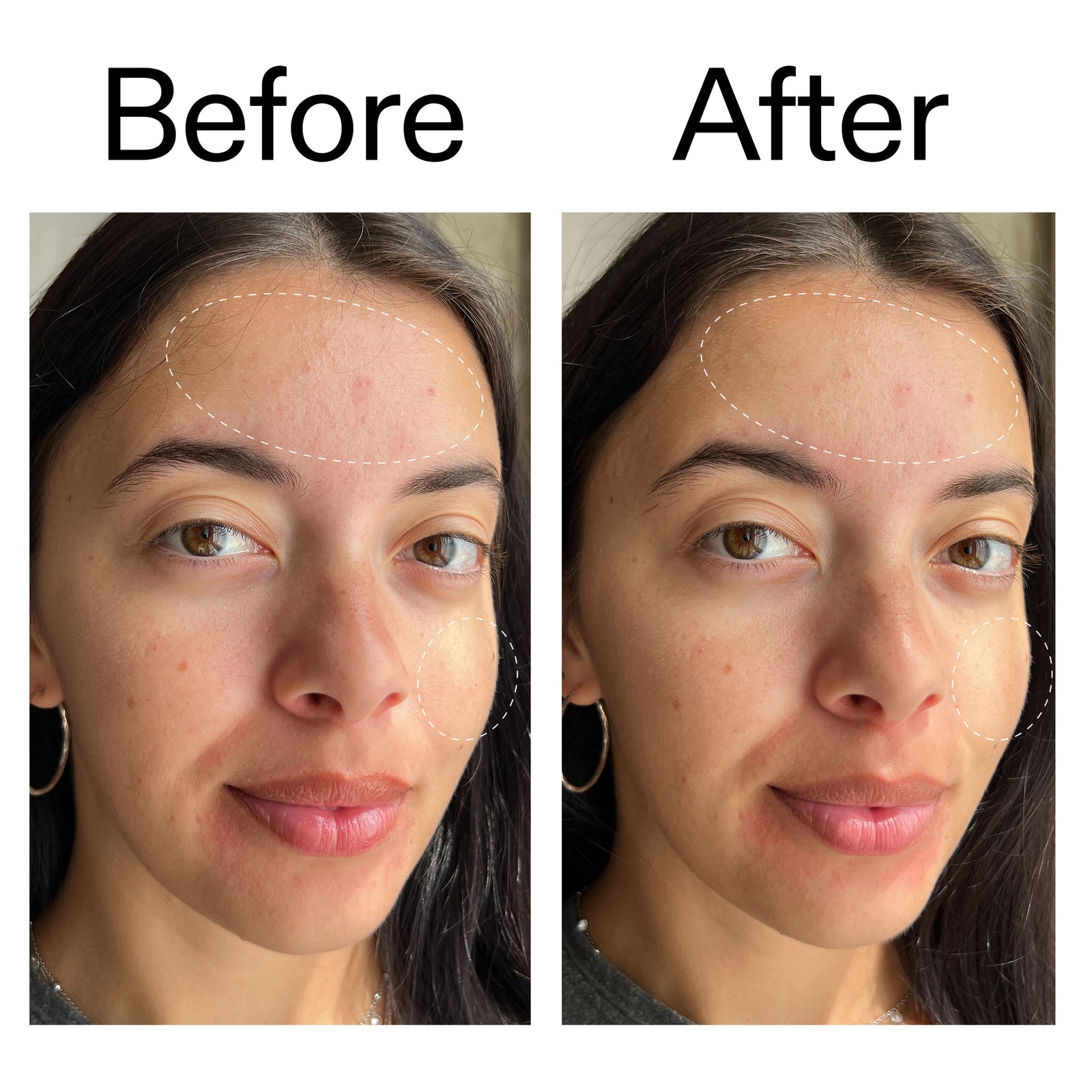 Before and after showing reduced breakouts and redness