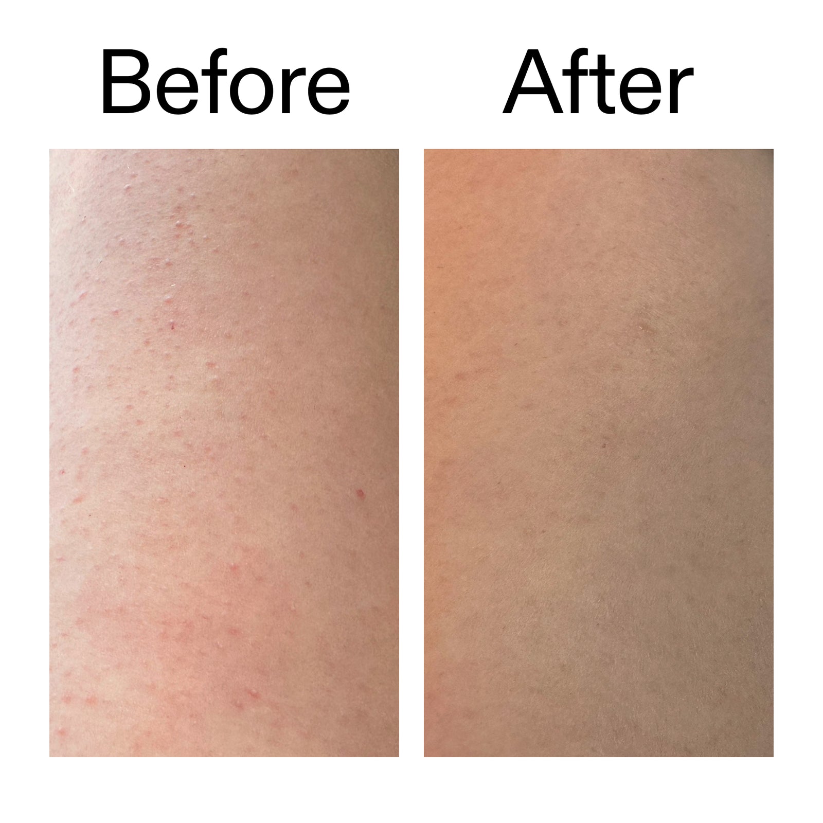 Before and after comparison of skin texture on a forearm, showing red, bumpy skin on the left labeled 'Before' and smoother, clearer skin on the right labeled 'After'.