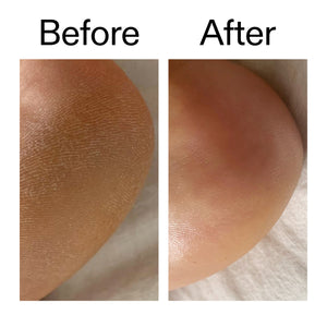 Before and after comparison of cracked heel on a white background
