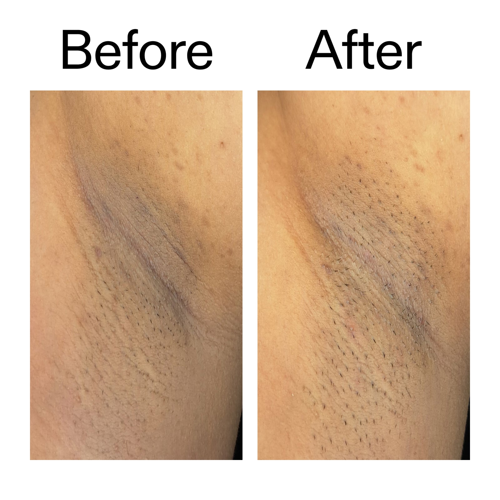 Before and after comparison of discoloured armpit 
