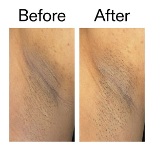 Before and after comparison of discoloured armpit 