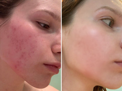 Before & after of using Hyaluronic Acid Serum