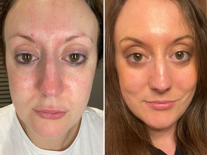 Before & after of using Hyaluronic Acid Serum