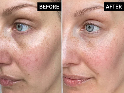 Before and after comparison of a woman's face with visible skin improvement.