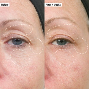 Before and after showing firmer skin around eyes