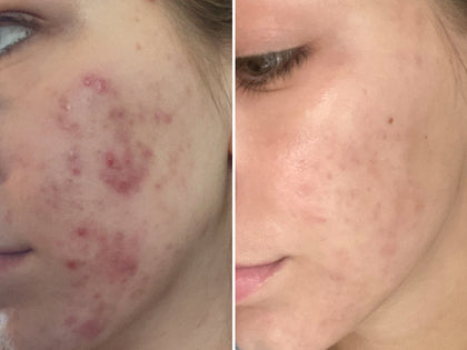 Before and after images of a customer to show how The INKEY List products cleared her blemishes.