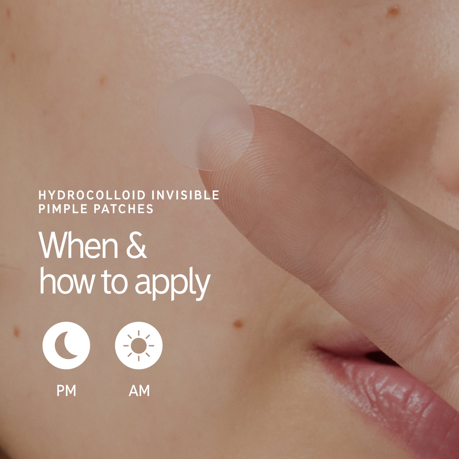 When and how to use Pimple Patches